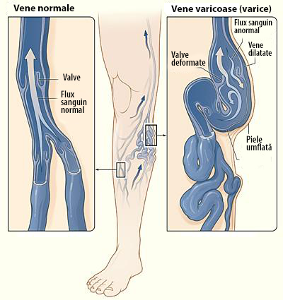 poate venele păianjen să provoace dureri de genunchi poate varicele provoca umflarea gambei