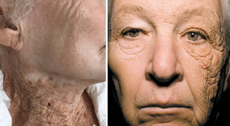 persoane afectate de radiatiile UV